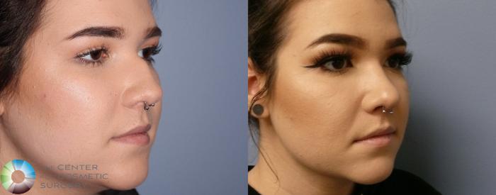 Before & After Rhinoplasty Case 899 View #2 in Denver and Colorado Springs, CO