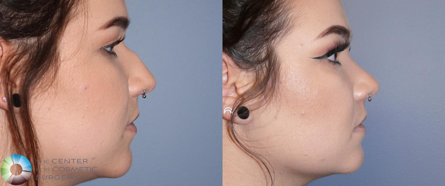 Before & After Rhinoplasty Case 899 View #3 View in Denver & Golden, CO