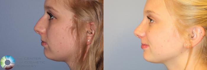 Before & After Rhinoplasty Case 972 View #1 View in Golden, CO