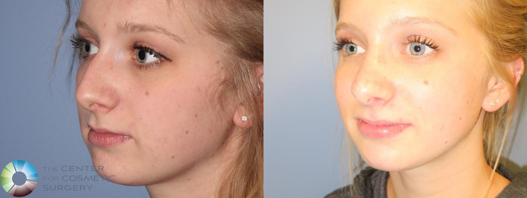 Before & After Rhinoplasty Case 972 View #2 in Denver and Colorado Springs, CO