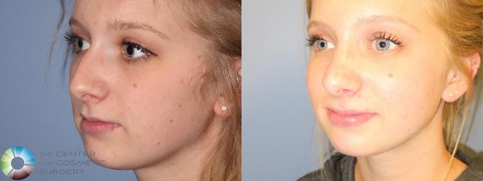 Before & After Rhinoplasty Case 972 View #2 View in Golden, CO