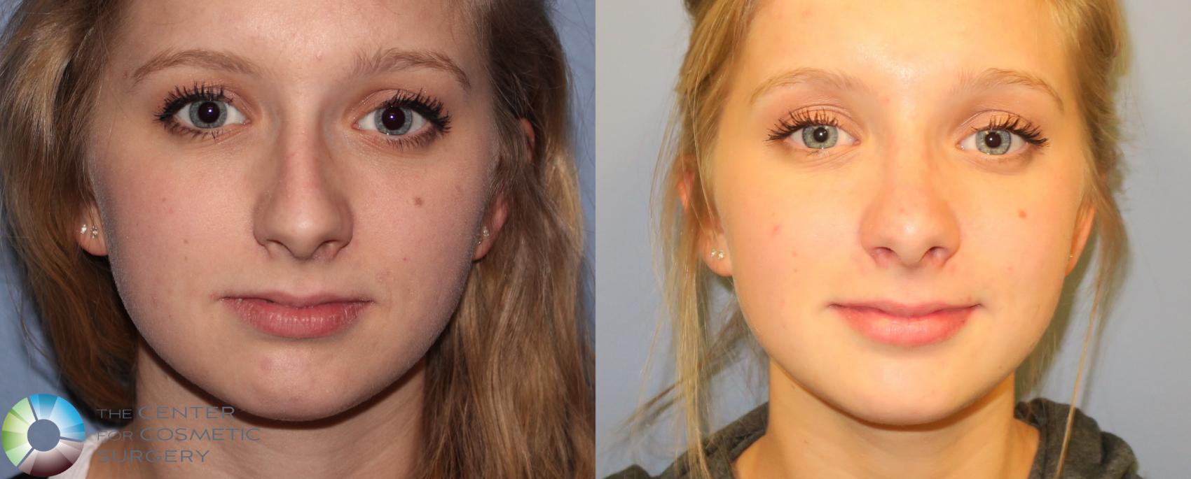 Before & After Rhinoplasty Case 972 View #3 in Denver and Colorado Springs, CO