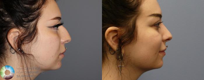 Before & After Rhinoplasty Case 973 View #1 in Denver and Colorado Springs, CO
