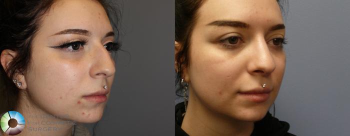 Before & After Rhinoplasty Case 973 View #2 in Denver and Colorado Springs, CO