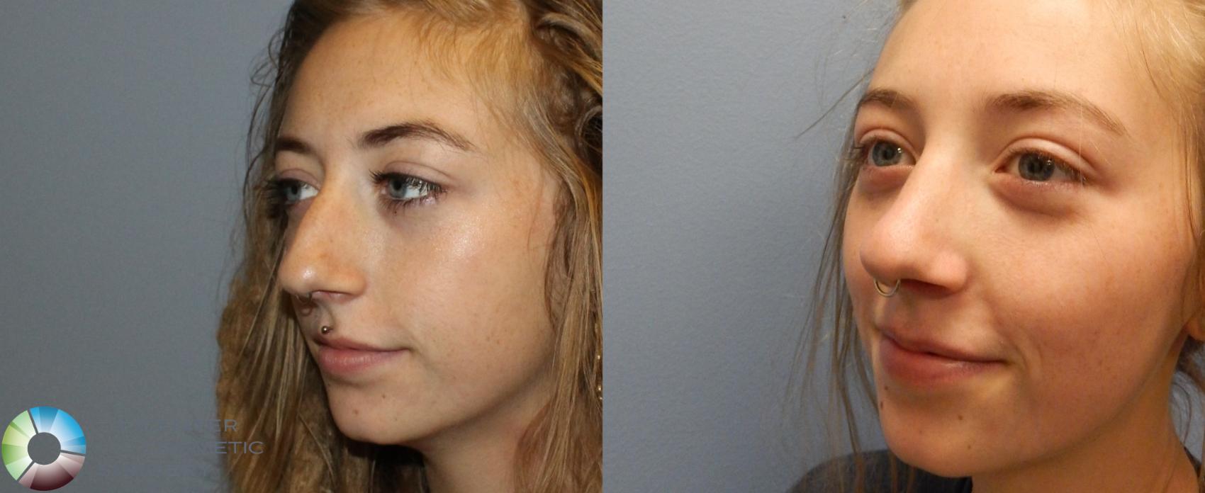 Before & After Rhinoplasty Case 979 View #2 View in Denver & Golden, CO