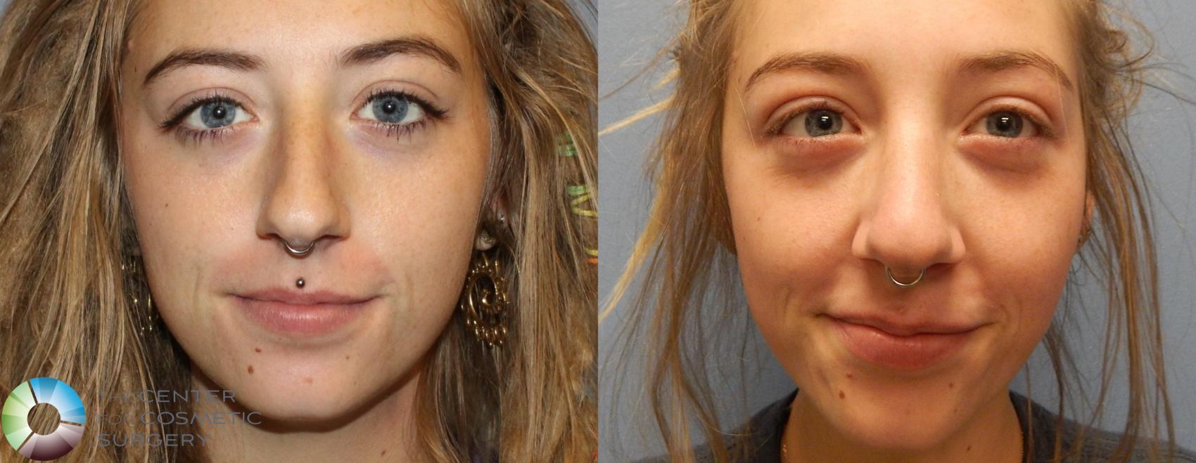 Before & After Rhinoplasty Case 979 View #3 View in Denver & Golden, CO