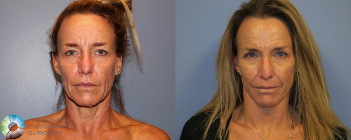Before & After Mini Facelift Case 12191 Front in Denver and Colorado Springs, CO
