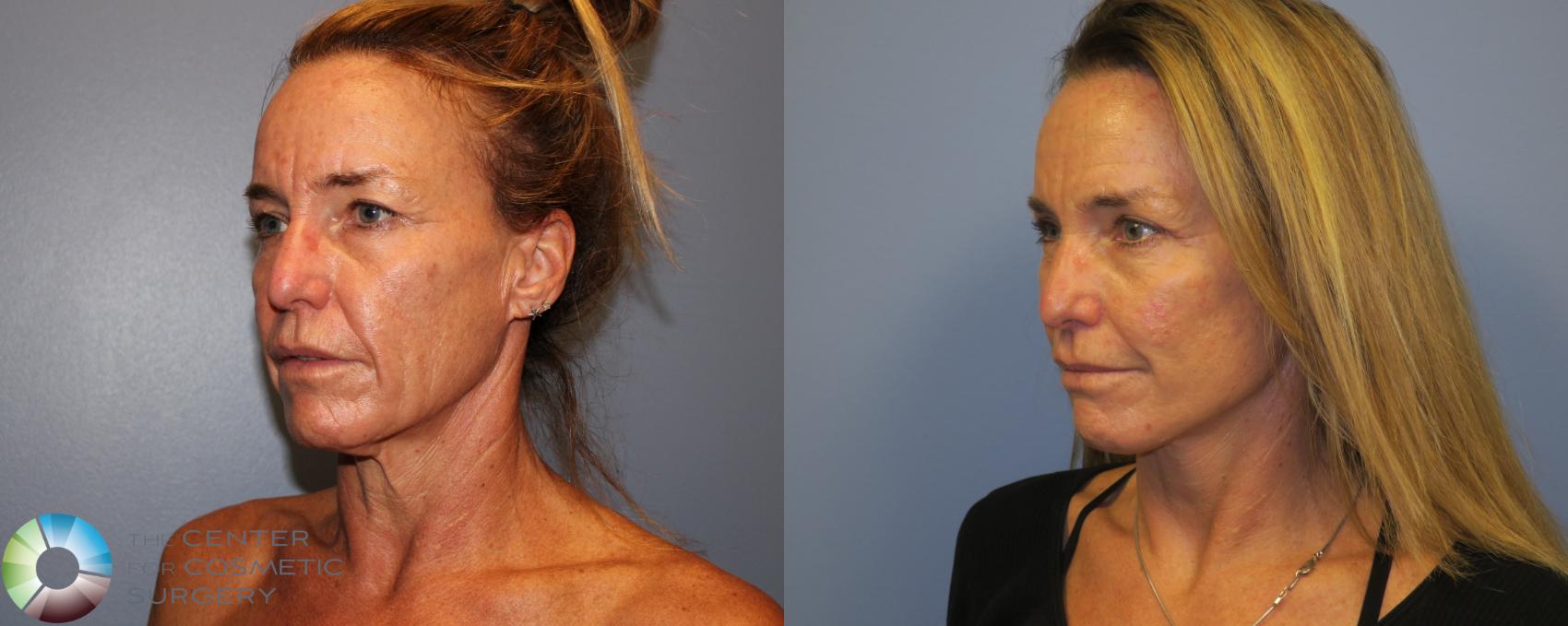 Before & After SMAS Facelift Case 12191 Left Oblique in Denver and Colorado Springs, CO
