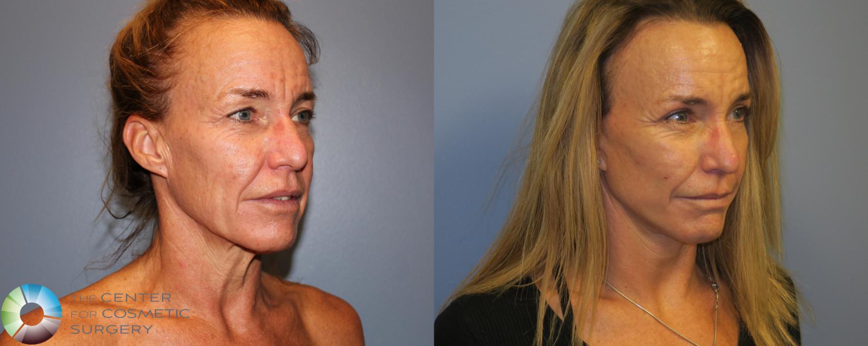 Before & After SMAS Facelift Case 12191 Right Oblique in Denver and Colorado Springs, CO