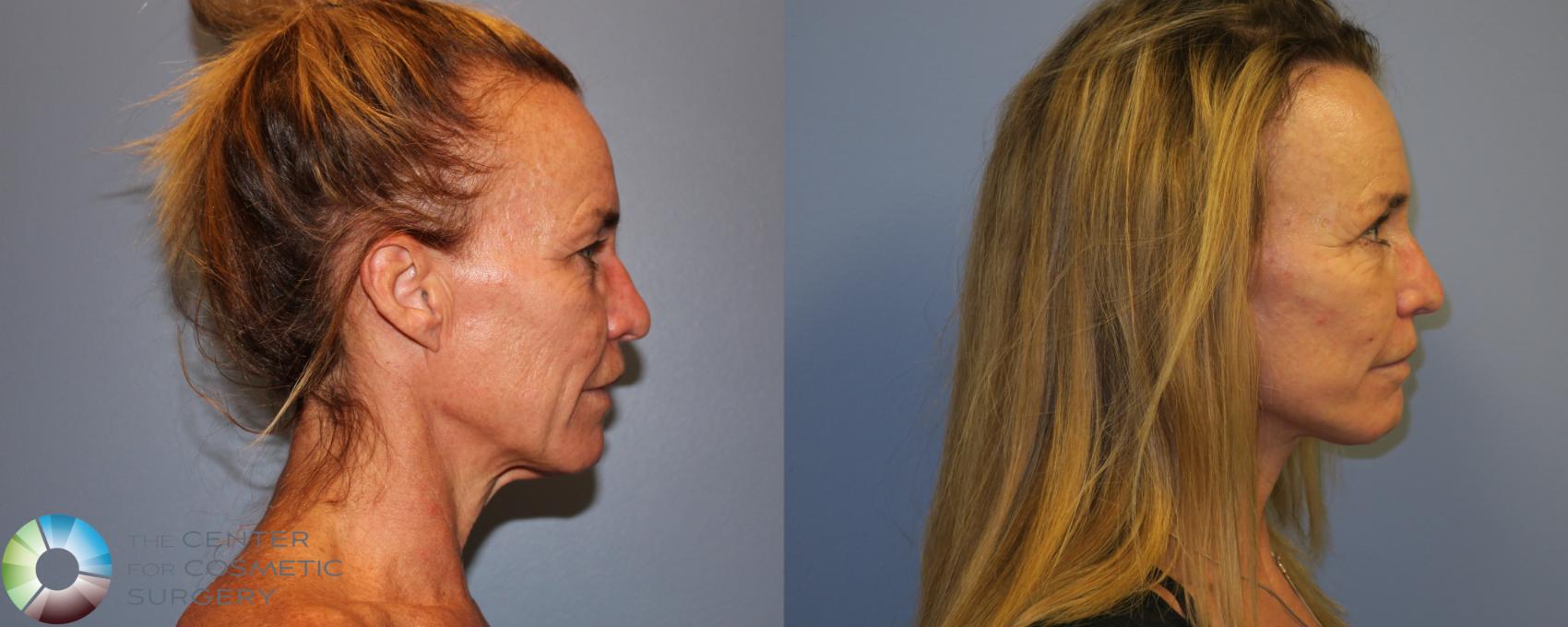 Before & After SMAS Facelift Case 12191 Right Side in Denver and Colorado Springs, CO