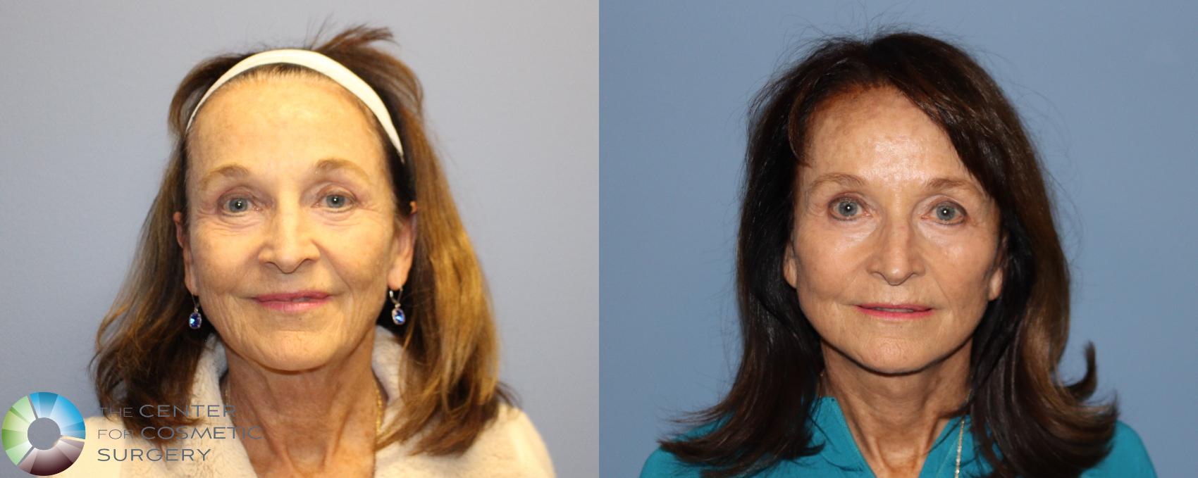 Before & After Neck Lift Case 12192 Front in Denver and Colorado Springs, CO