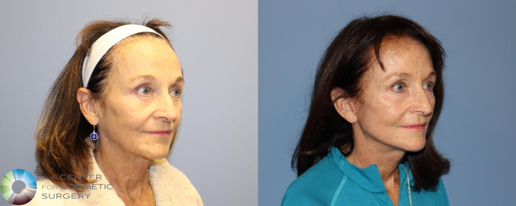 Before & After SMAS Facelift Case 12192 Right Oblique in Denver and Colorado Springs, CO