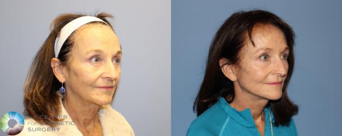 Before & After Neck Lift Case 12192 Right Oblique in Denver and Colorado Springs, CO