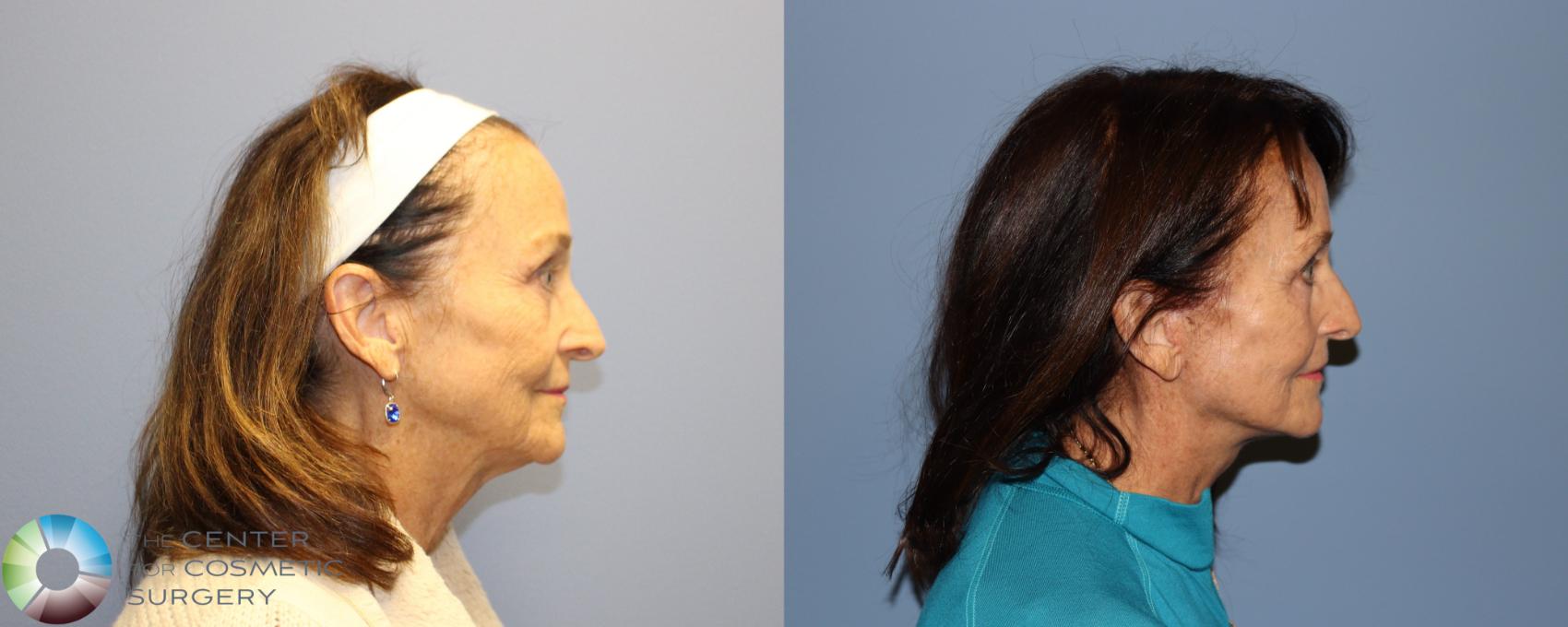Before & After SMAS Facelift Case 12192 Right Side in Denver and Colorado Springs, CO