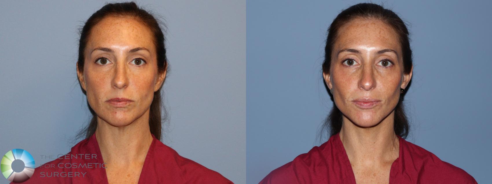 Before & After SMAS Facelift Case 12193 Front in Denver and Colorado Springs, CO