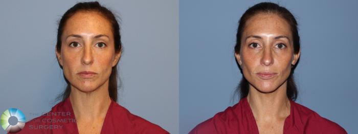 Before & After SMAS Facelift Case 12193 Front in Denver and Colorado Springs, CO