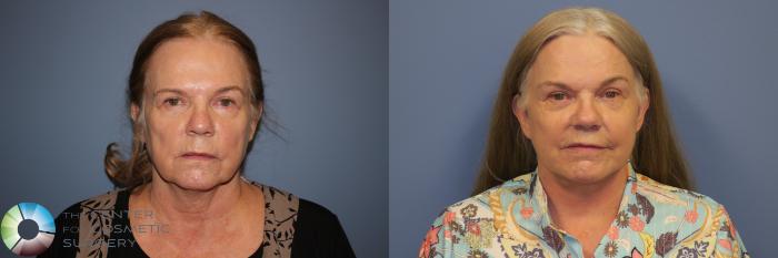 Before & After SMAS Facelift Case 12194 Front in Denver and Colorado Springs, CO