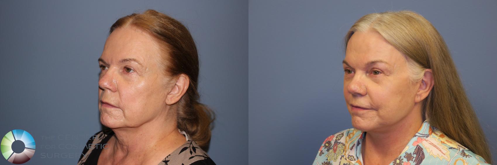 Before & After SMAS Facelift Case 12194 Left Oblique in Denver and Colorado Springs, CO