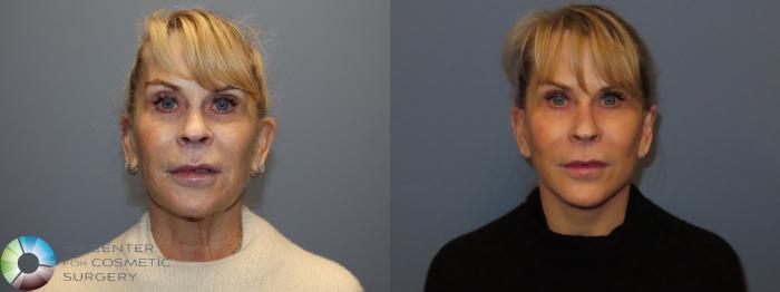 Before & After SMAS Facelift Case 12195 Front in Denver and Colorado Springs, CO