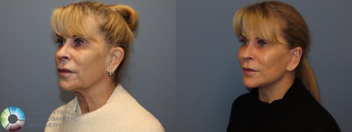 Before & After SMAS Facelift Case 12195 Left Oblique in Denver and Colorado Springs, CO
