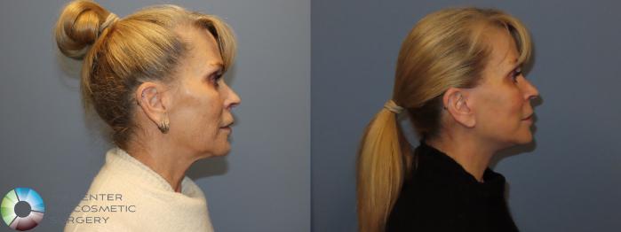 Before & After SMAS Facelift Case 12195 Right Side in Denver and Colorado Springs, CO