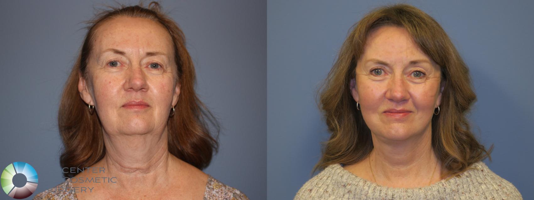 Before & After SMAS Facelift Case 12198 Front in Denver and Colorado Springs, CO
