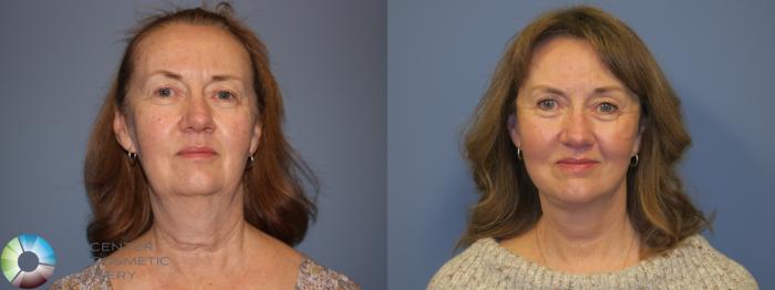 Before & After SMAS Facelift Case 12198 Front in Denver and Colorado Springs, CO