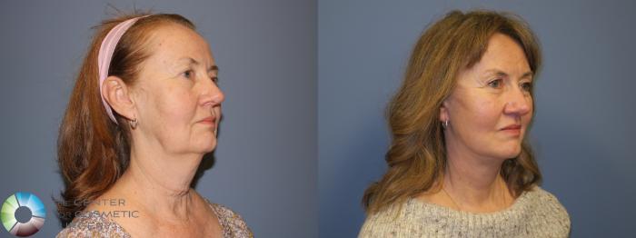 Before & After SMAS Facelift Case 12198 Right Oblique in Denver and Colorado Springs, CO