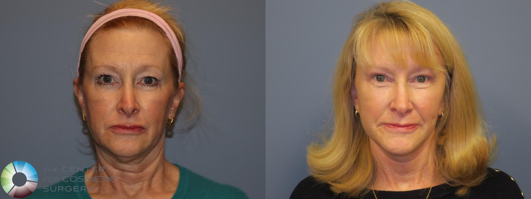 Before & After SMAS Facelift Case 12199 Front in Denver and Colorado Springs, CO