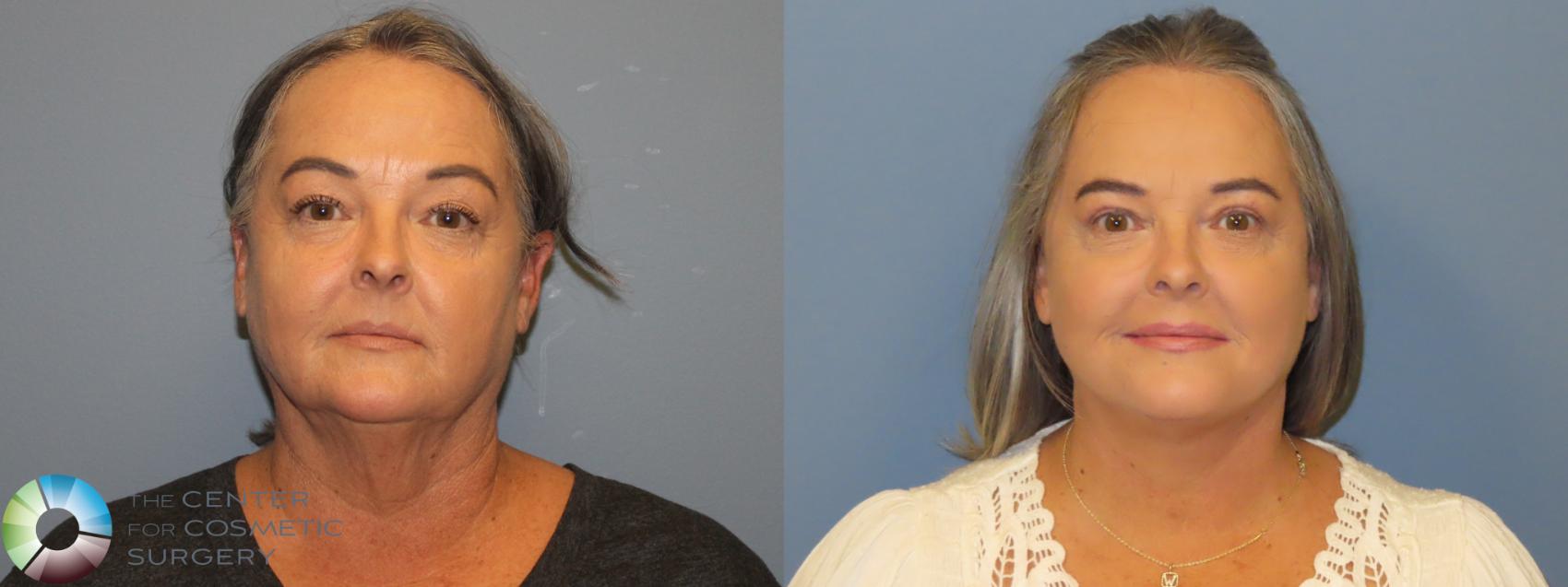 Before & After SMAS Facelift Case 12200 Front in Denver and Colorado Springs, CO