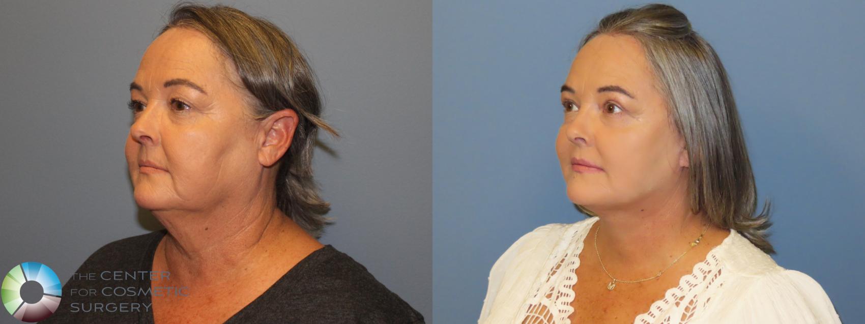 Before & After SMAS Facelift Case 12200 Left Oblique in Denver and Colorado Springs, CO