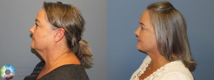 Before & After SMAS Facelift Case 12200 Left Side in Denver and Colorado Springs, CO