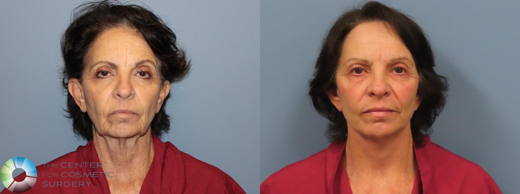 Before & After SMAS Facelift Case 12201 Front in Denver and Colorado Springs, CO
