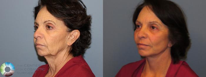 Before & After SMAS Facelift Case 12201 Left Oblique in Denver and Colorado Springs, CO