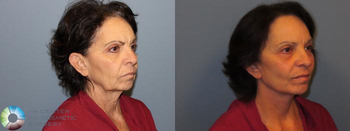 Before & After SMAS Facelift Case 12201 Right Oblique in Denver and Colorado Springs, CO