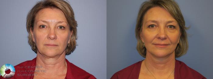 Before & After SMAS Facelift Case 12202 Front in Denver and Colorado Springs, CO