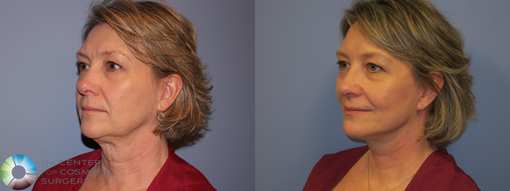 Before & After SMAS Facelift Case 12202 Left Oblique in Denver and Colorado Springs, CO
