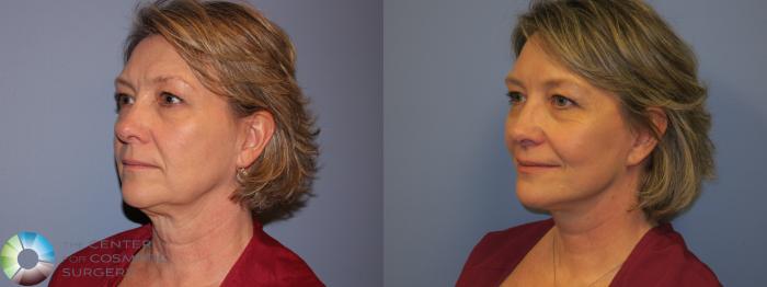 Before & After SMAS Facelift Case 12202 Left Oblique in Denver and Colorado Springs, CO