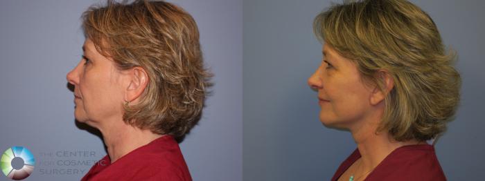Before & After SMAS Facelift Case 12202 Left Side in Denver and Colorado Springs, CO