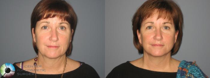 Before & After SMAS Facelift Case 12203 Front in Denver and Colorado Springs, CO