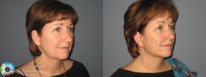 Before & After SMAS Facelift Case 12203 Right Oblique in Denver and Colorado Springs, CO