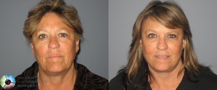 Before & After SMAS Facelift Case 12204 Front in Denver and Colorado Springs, CO