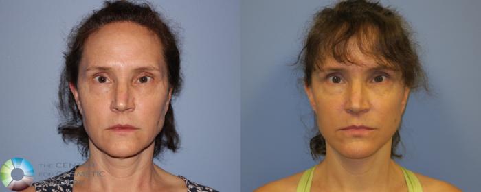 Before & After SMAS Facelift Case 12205 Front in Denver and Colorado Springs, CO