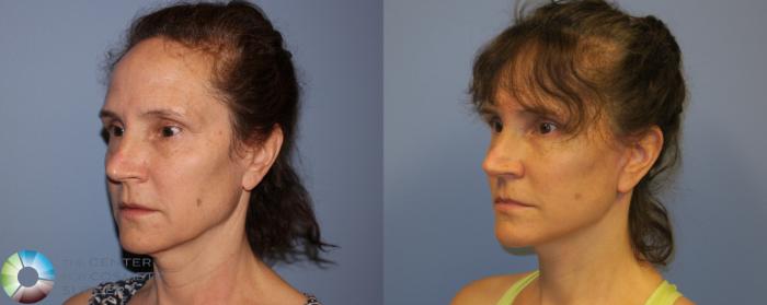 Before & After SMAS Facelift Case 12205 Left Oblique in Denver and Colorado Springs, CO