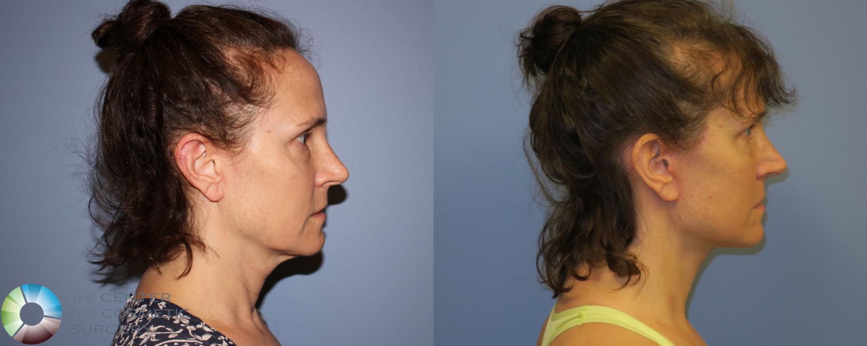 Before & After SMAS Facelift Case 12205 Right Side in Denver and Colorado Springs, CO