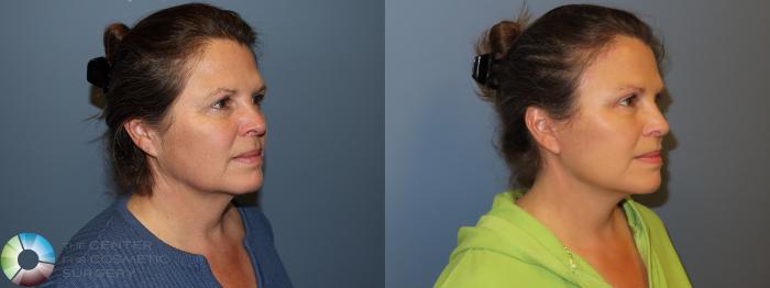 Before & After SMAS Facelift Case 12206 Right Oblique in Denver and Colorado Springs, CO