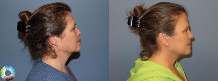 Before & After SMAS Facelift Case 12206 Right Side in Denver and Colorado Springs, CO