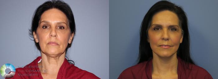 Before & After SMAS Facelift Case 12207 Front in Denver and Colorado Springs, CO