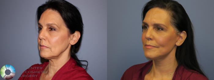 Before & After SMAS Facelift Case 12207 Left Oblique in Denver and Colorado Springs, CO
