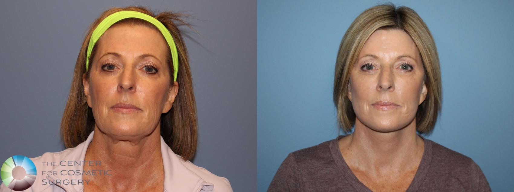 Before & After SMAS Facelift Case 12208 Front in Denver and Colorado Springs, CO